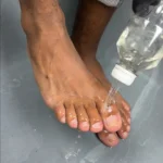 Vinegar treatment for yellow and dry nails affected by nail fungus.